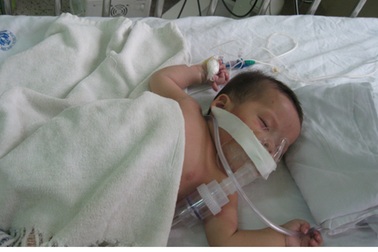 Bé không có hậu môn và tim bẩm sinh vẫn trong tình trạng nguy hiểm