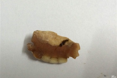 Tức ngực, khó thở vì răng giả chui vào dạ dày