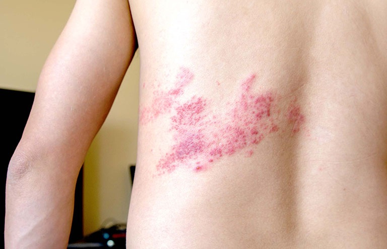 Đã khỏi zona nhưng cơn đau không dứt: Giải pháp mới từ điện quang can thiệp - 1