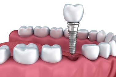 Lớp phủ cấy ghép nha khoa chống nhiễm trùng với ba hướng tấn công