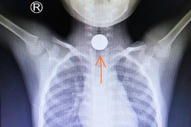 Nuốt đồng xu khi đi chúc Tết, bé trai 5 tuổi mắc nghẹn nguy kịch