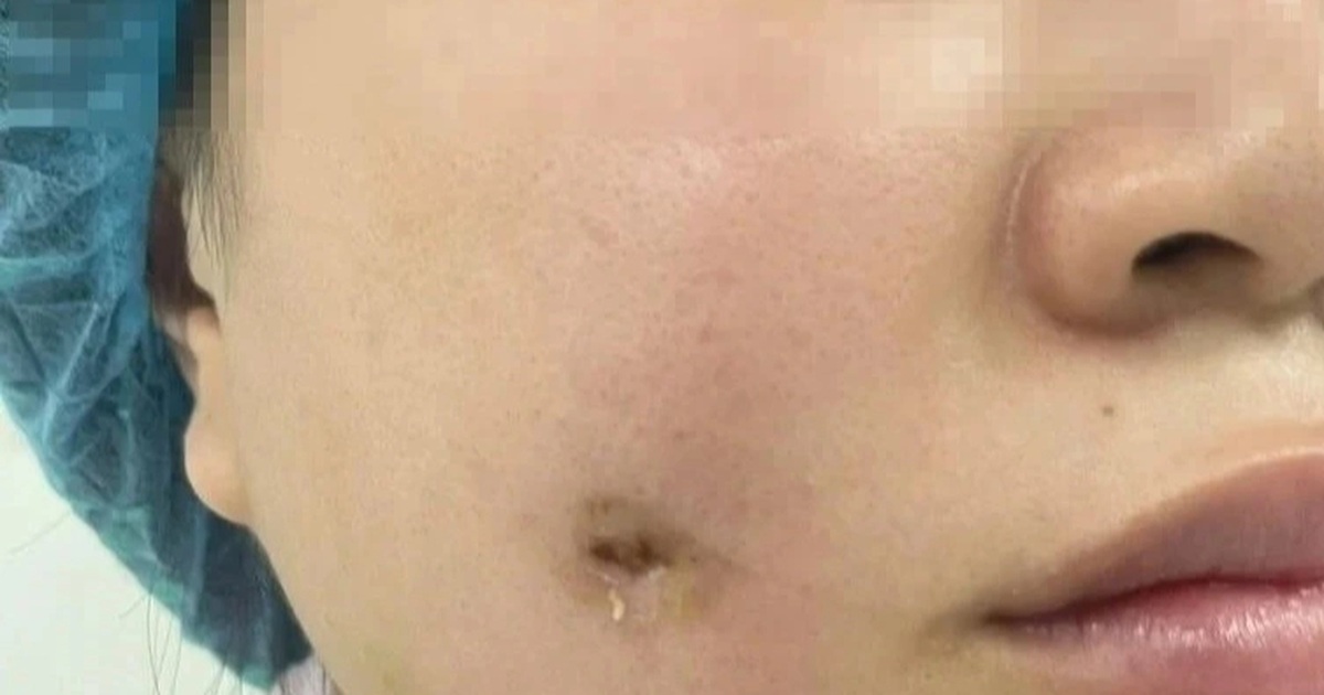 Người phụ nữ bị nhiễm trùng sau khi làm má lúm đồng tiền tại spa