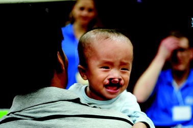 Đăng ký phẫu thuật nụ cười miễn phí cho trẻ hở hàm ếch