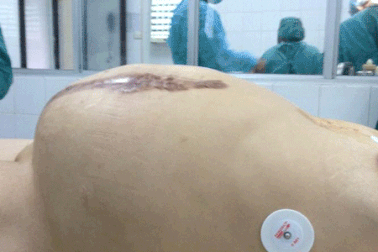 Phẫu thuật khối u “khủng” 14 kg trong bụng bệnh nhân