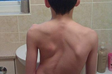 Cao thêm 12cm sau phẫu thuật cột sống