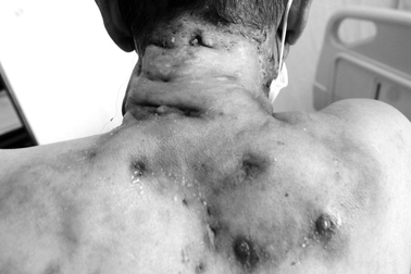 Căn bệnh hiếm gặp khiến người đàn ông chảy mủ khắp người