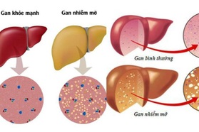 Hai biến chứng nguy hiểm của gan nhiễm mỡ