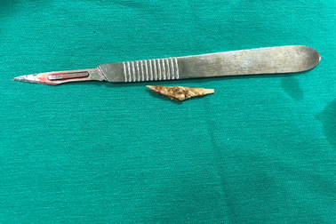 Đau bụng nhiều năm, thanh niên tá hỏa khi biết bị thủng ruột