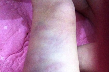 Đình chỉ giáo viên đánh bầm tím chân bé gái hơn 2 tuổi