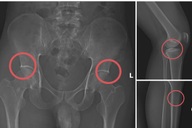 Tự đục vỡ xương để “qua mặt” bảo hiểm