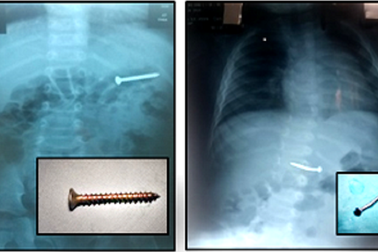 Cha mẹ sơ ý, 2 trẻ nhỏ suýt thủng ruột vì nuốt đinh