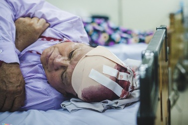 Mổ lấy được cục máu đông gây đột quỵ dài gần 10cm