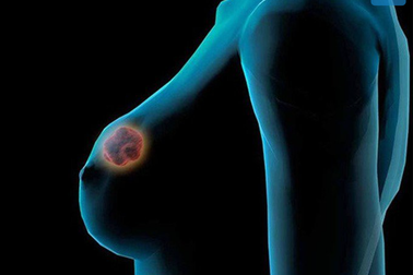 Đột biến gen khiến phụ nữ dễ mắc loại ung thư vú nguy hiểm