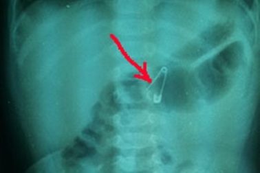 Mẹ sơ ý, bé 6 tháng tuổi nuốt kim băng