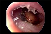 Rợn người xem cảnh bác sĩ gắp gián ra từ tai bệnh nhân