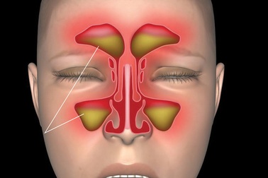 Giảm nỗi lo viêm xoang nhờ thực phẩm bảo vệ sức khoẻ Toxana