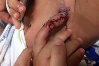 Phẫu thuật nối liền tay vào bụng để “nuôi” ngón tay bị đứt rời