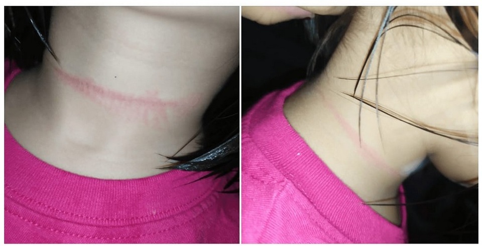Bé gái 4 tuổi suýt mất mạng vì học theo video treo cổ trên TikTok - 1 Bé gái 4 tuổi suýt mất mạng vì học theo video treo cổ trên TikTok - 1