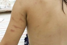 Bé gái 2 tuổi xuất hiện những vết bầm tím trên người lúc ở trường mầm non