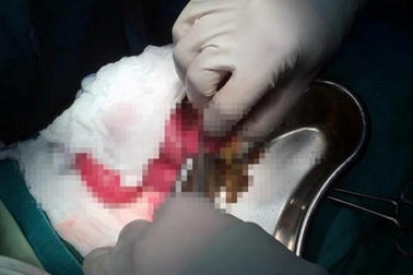 Tắc ruột non vì khối hạt ổi to 10cm