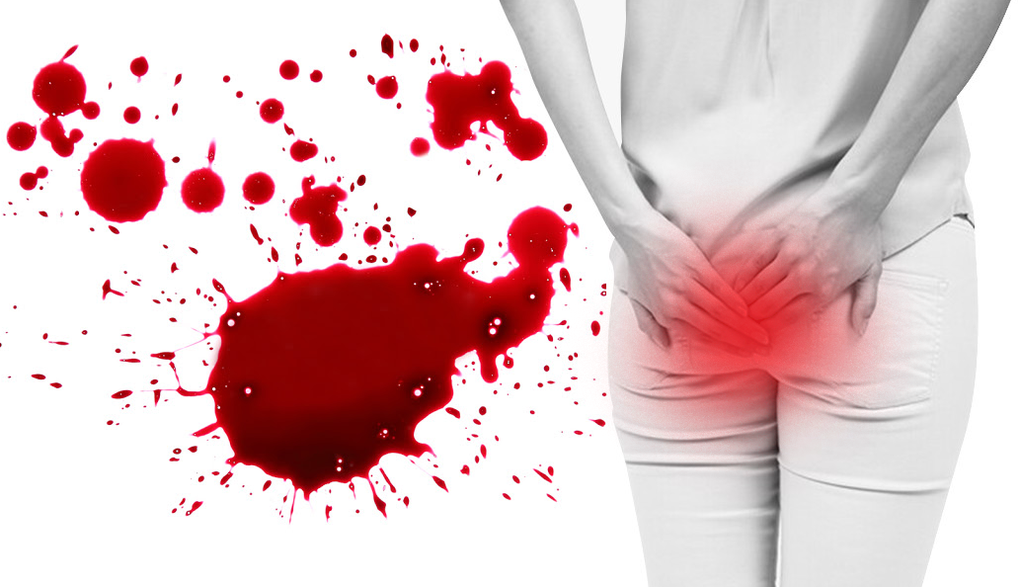 Từ chối mổ về nhà ăn Tết, bệnh nhân trĩ mất 2/3 lượng máu cơ thể - 1 Từ chối mổ về nhà ăn Tết, bệnh nhân trĩ mất 2/3 lượng máu cơ thể - 1