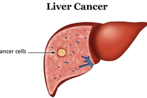 Các phương pháp điều trị ung thư gan hiện nay?