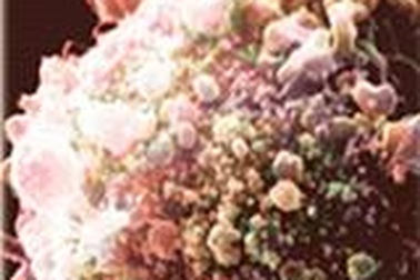 Phát hiện virus HIV ở mắt người