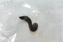 Gắp con đỉa sống trong khí quản bé trai 13 tuổi