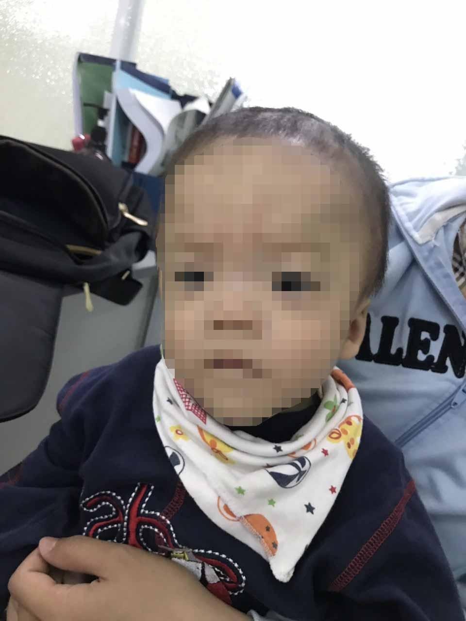 Kỳ lạ bệnh nhi đầu hình tam giác bẩm sinh hiếm gặp - 2