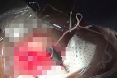 Sán dài 7cm ngọ nguậy trong mắt bệnh nhân