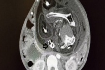 Bào thai có tóc và dương vật trong bụng thiếu niên 15 tuổi