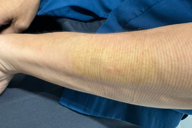 Quét dọn vườn trong resort ở Phú Quốc, nam thanh niên bị rắn độc cắn