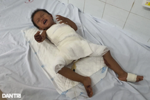 Lặng người trước bé 2 tuổi bị bỏng nặng vì ngã vào nồi cám lợn