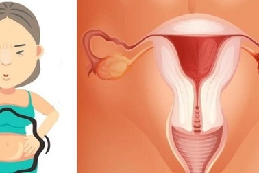 Chị em cần cảnh giác khi bụng to dần, hay có cảm giác đầy bụng