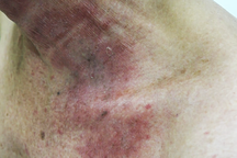 TPHCM: Hàng trăm người biến dạng da vào viện cầu cứu vì dịch độc của kiến