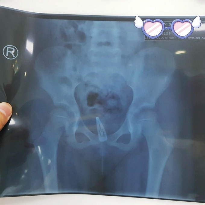 Bé 5 tuổi điều trị viêm âm đạo hơn 3 tháng không khỏi, một lần vệ sinh cho bé người mẹ phát hiện ra nguyên nhân - Ảnh 1. Bé 5 tuổi điều trị viêm âm đạo hơn 3 tháng không khỏi, một lần vệ sinh cho bé người mẹ phát hiện ra nguyên nhân - Ảnh 1.