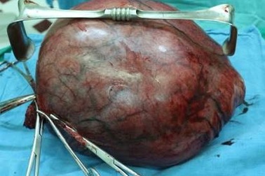 Phẫu thuật khối u xơ tử cung nặng gần 8kg