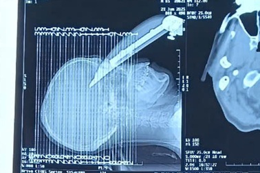 Kịp thời cứu sống bệnh nhân bị lưỡi dao máy cắt cắm xuyên sọ não