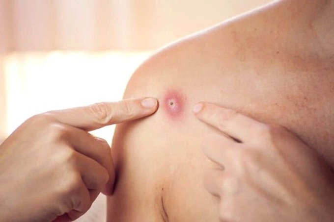 Long An ghi nhận ca mắc bệnh đậu mùa khỉ đầu tiên. Ảnh minh họa