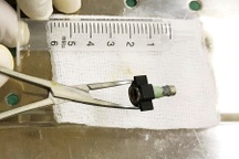 Đang ngồi chơi, bé gái 8 tuổi bất ngờ bị dị vật lọt vào vùng kín