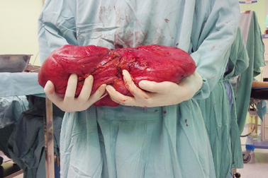 Mục sở thị khối u mỡ nặng tới 6kg trong ổ bụng