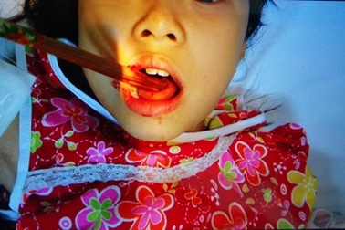 Bé gái bị đôi đũa đâm xuyên lưỡi vì ăn ở sân chơi bóng