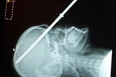 Rùng mình thiếu niên vô tình tự bắn súng phóng lao xuyên đầu vào sọ