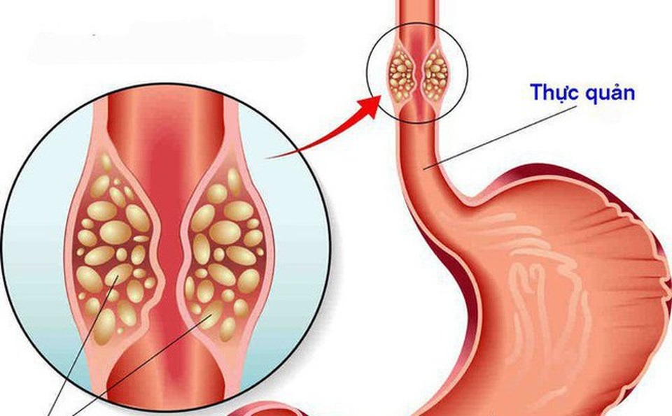 6 yếu tố nguy cơ khiến bạn dễ mắc ung thư thực quản - 1 6 yếu tố nguy cơ khiến bạn dễ mắc ung thư thực quản - 1