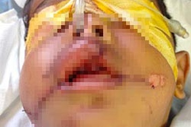 Vá mặt, nối hàm cứu bé trai bị nạn