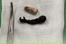 Gắp dị vật "cánh tay robot" ở vùng kín bé gái 5 tuổi