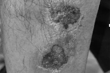 Tự ý tăng liều cho nhanh khỏi, nhiều bệnh nhân ngộ độc thuốc