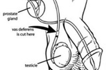 Thắt ống dẫn tinh gây ung thư tuyến tiền liệt?