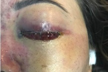 'Sờ gáy' spa làm mù mắt cô gái sau tiêm filler nâng mũi