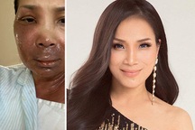 Nghệ sĩ Việt sốc khi Hồng Ngọc chia sẻ khuôn mặt bị bỏng nghiêm trọng